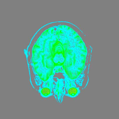 MRI brain scan